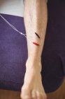 Primer plano de un paciente recibiendo agujas electro-secas en la pierna - foto de stock
