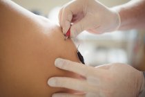 Close-up of physiotherapist inserting needles on patient for electro dry needling — Stock Photo