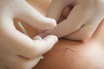 Close-up of physiotherapist inserting needle for dry needling on patient — Stock Photo