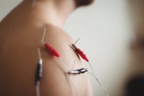 Nahaufnahme eines männlichen Patienten, der sich elektrotrockene Nadeln auf die Schulter bekommt — Stockfoto