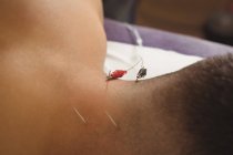 Крупним планом пацієнт отримує електросухе плетіння на спині шиї в клініці — стокове фото