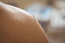 Nahaufnahme eines männlichen Patienten, der trockene Nadeln auf der Schulter bekommt — Stockfoto