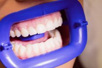 Пациентка получает легкое лечение зубов в стоматологической клинике, крупным планом — стоковое фото