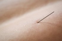 Крупный план пациента с сухой иглой на спине — стоковое фото