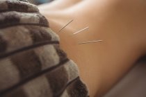 Close-up de paciente do sexo masculino recebendo agulhas secas na cintura — Fotografia de Stock