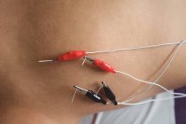 Primer plano del paciente recibiendo agujas electro secas en el hombro en la clínica - foto de stock