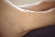 Primo piano del paziente che si asciuga con l'ago sulla gamba — Foto stock