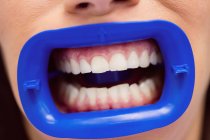 Patientin erhält leichte Zahnbehandlung in Zahnklinik, Nahaufnahme — Stockfoto
