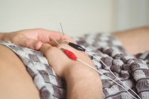Primo piano di un paziente che ottiene aghi elettro-asciutti a portata di mano — Foto stock