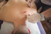 Primer plano del fisioterapeuta que realiza agujas electrosecas en la espalda de un paciente en la clínica - foto de stock