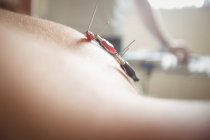 Close-up of patient getting electro dry needling on shoulder in clinic — Stock Photo