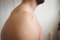 Primer plano del paciente masculino recibiendo agujas secas en el hombro - foto de stock