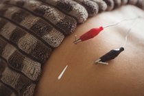 Nahaufnahme einer Patientin, die elektrisch trockene Nadeln an der Taille bekommt — Stockfoto