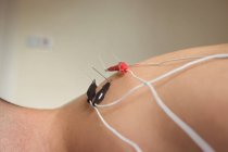 Nahaufnahme einer Patientin, die in der Klinik trockene Nadeln an der Schulter bekommt — Stockfoto