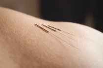 Close-up of three needles for dry needling on skin — Stock Photo
