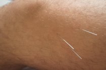 Primer plano del paciente masculino recibiendo agujas secas en la rodilla - foto de stock