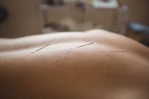 Close-up do paciente recebendo agulhas secas nas costas — Fotografia de Stock