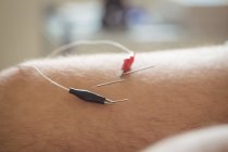 Nahaufnahme einer Patientin, die elektrische Nadeln am Knie bekommt — Stockfoto