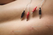 Крупним планом пацієнт отримує електросухе плетіння на спині в клініці — стокове фото