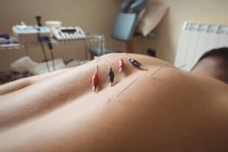 Close-up of patient getting electro dry needling on back in clinic — Stock Photo