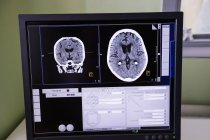 Digital brain scan on computer monitor in hospital — Stock Photo