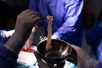 Nahaufnahme der Hand des Chirurgen, der ein Stück Menschenfleisch in eine Schüssel legt, während er eine Operation über einem Patienten durchführt — Stockfoto