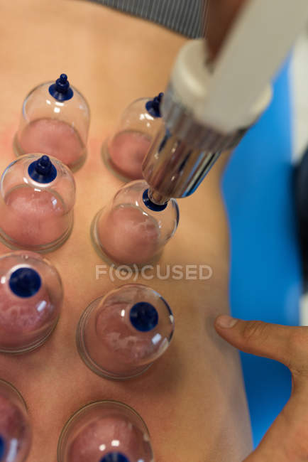 Mulher deitada no peito com cupping terapia nas costas na clínica — Fotografia de Stock