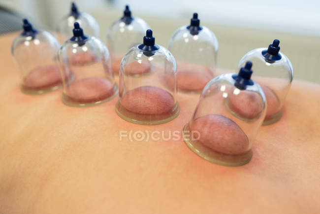 Woman lying on chest with cupping therapy on back in clinic — Stock Photo