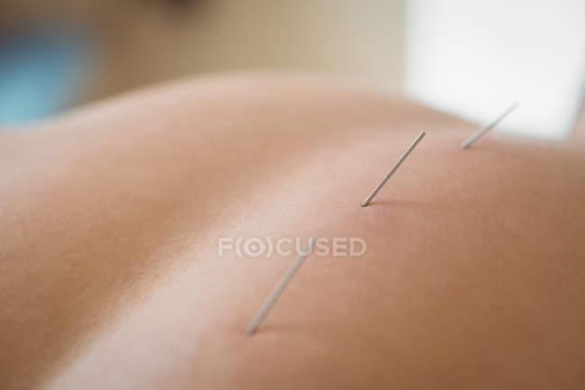 Close-up do paciente recebendo agulhas secas nas costas — Fotografia de Stock