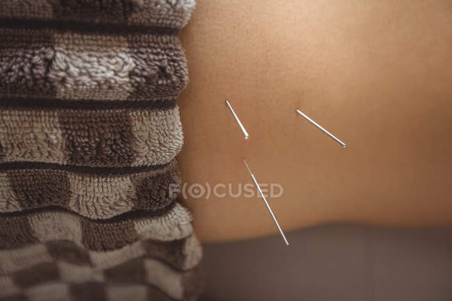 Primer plano del paciente masculino recibiendo agujas secas en la cintura - foto de stock