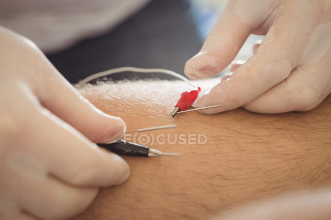 Primo piano delle mani del fisioterapista che eseguono l'ago elettro-secco sul ginocchio del paziente maschio — Foto stock