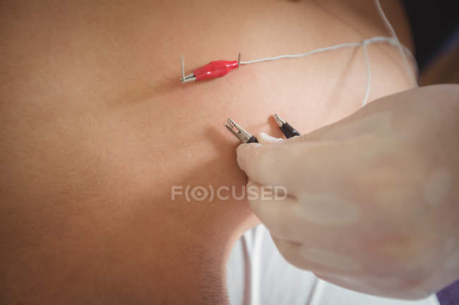 Gros plan d'un physiothérapeute effectuant des aiguilles électro-sèches sur le dos d'un patient en clinique — Photo de stock