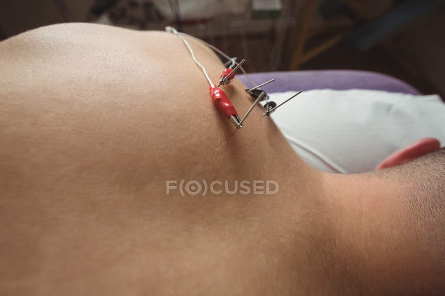 Primo piano del paziente che ottiene l'ago elettro asciutto sulla spalla in clinica — Foto stock