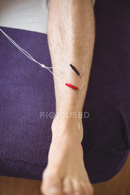 Крупним планом пацієнт отримує електросухе плетіння на нозі — стокове фото