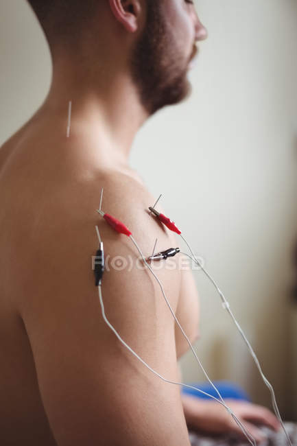 Close-up of male patient getting electro dry needling on shoulder — Stock Photo