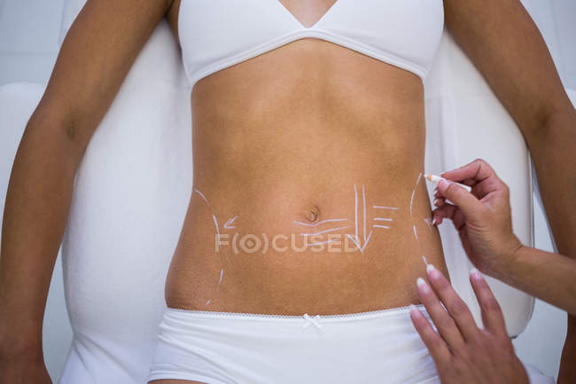Close-up do cirurgião traçando linhas no abdômen feminino para lipoaspiração e remoção de celulite — Fotografia de Stock