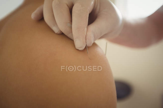 Close-up of physiotherapist performing dry needling on shoulder of patient in clinic — Stock Photo
