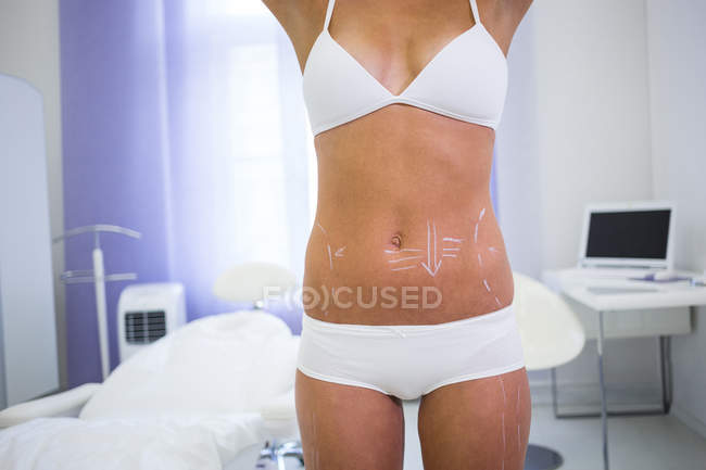 Mittelteil des weiblichen Körpers mit Zeichnungsmarken für den Bauch zur Fettabsaugung und Entfernung von Cellulite — Stockfoto