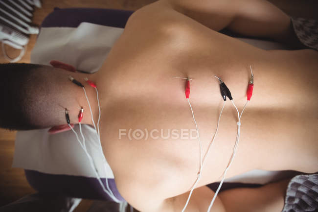 Primer plano del paciente recibiendo agujas electro secas de nuevo en la clínica - foto de stock