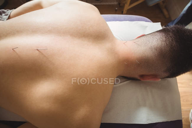 Крупним планом пацієнт отримує сухе плетіння на спині в клініці — стокове фото