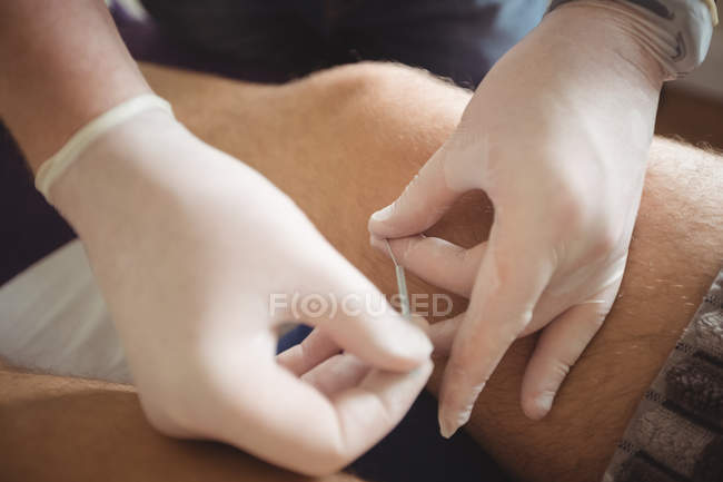 Крупный план физиотерапевта, выполняющего сухую иглу на колене пациента — стоковое фото