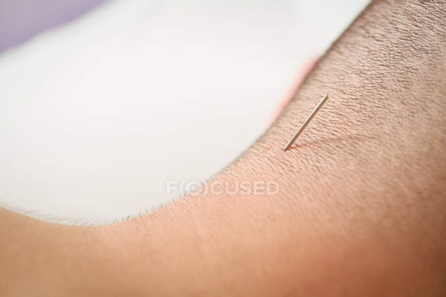 Primer plano del paciente masculino recibiendo agujas secas en el cuello - foto de stock
