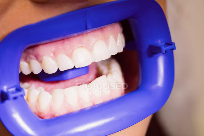 Paziente di sesso femminile che riceve un trattamento leggero dei denti presso la clinica dentale, primo piano — Foto stock