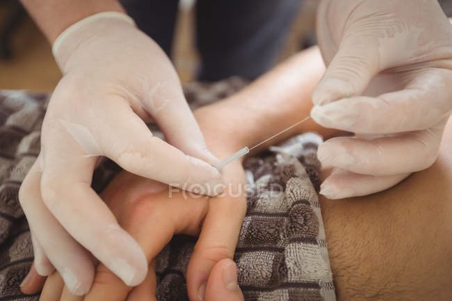 Крупный план физиотерапевта, выполняющего сухую иглу на руке пациента-мужчины в клинике — стоковое фото