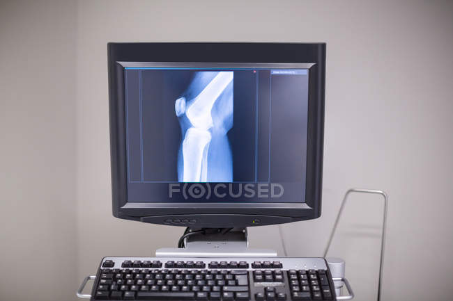Raio-X da articulação do joelho no computador pessoal no hospital — Fotografia de Stock