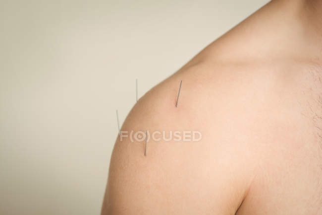Primer plano del paciente masculino recibiendo agujas secas en el hombro - foto de stock
