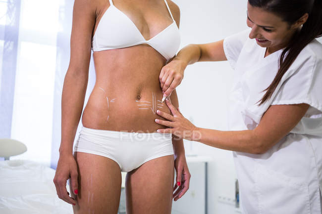 Gros plan du chirurgien tracer des lignes sur l'abdomen féminin pour la liposuccion et l'élimination de la cellulite — Photo de stock
