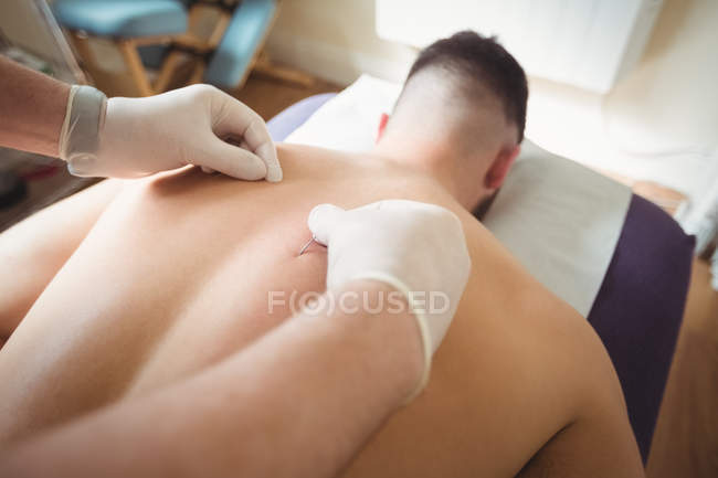 Primer plano del fisioterapeuta realizando agujas secas en la espalda del paciente en la clínica - foto de stock