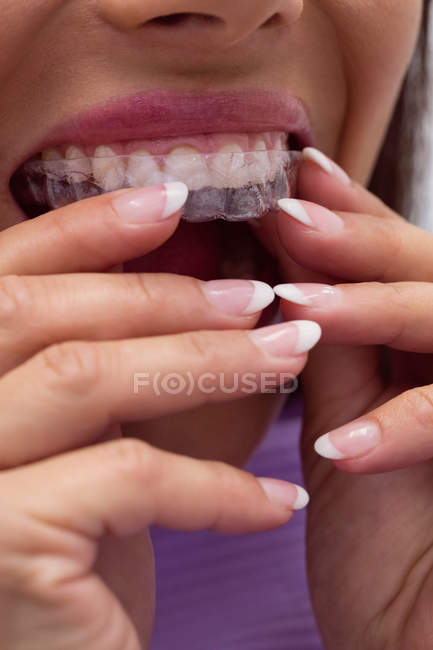 Gros plan d'une patiente portant un appareil dentaire avec les mains dans une clinique dentaire — Photo de stock