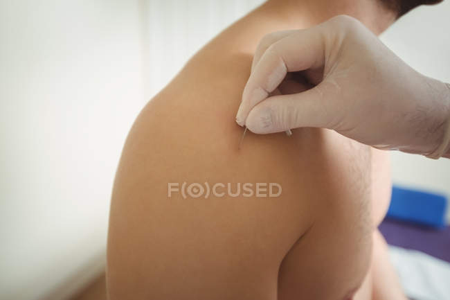Nahaufnahme des Physiotherapeuten, der trockene Nadeln an der Schulter des Patienten in der Klinik durchführt — Stockfoto